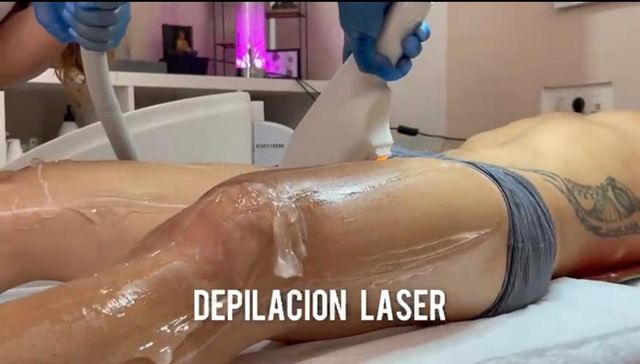 depilacion laser3